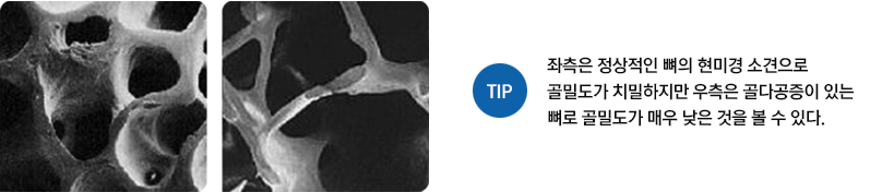 좌측은 정상적인 뼈의 현미경 소견으로 골밀도가 치밀하지만 우측은 골다공증이 있는 뼈로 골밀도가 매우 낮은 것을 볼 수 있다.