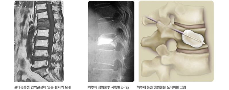 그림1 골다공증성 압박골절이 있는 환자의 MRI 그림2 척추체 성형술 후 시행 x-ray 그림3 척추체 풍성 성형술을 도식화한 그림
