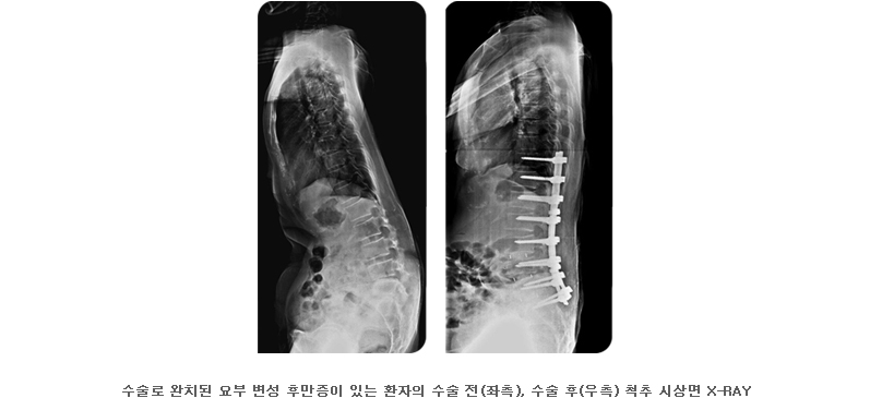 수술로 완치된 요부 변성 후만증이 있는 환자의 수술 전(좌측), 수술 후(우측) 척추 시상면 X-RAY